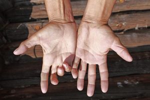 pair of mans hands from above | accident related degloving injuries