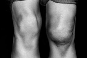 black and white photos of knees | Knee Injuries After a Car Accident