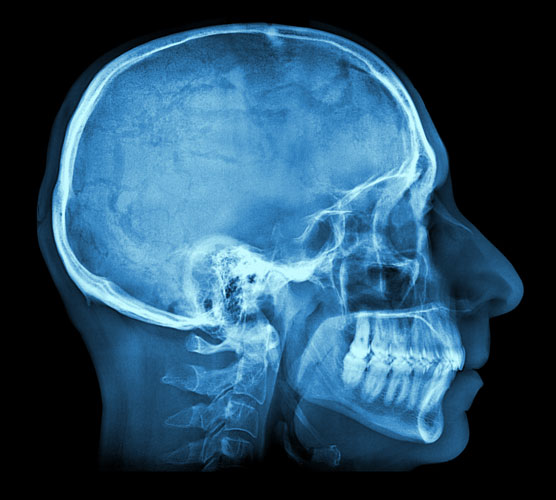 A blue xray of a mans skull | Colorado Springs Brain Injury Attorneys
